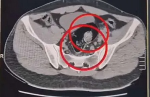 İran uyruklu 2 kuryenin makatından 307 gram uyuşturucu çıktı!
