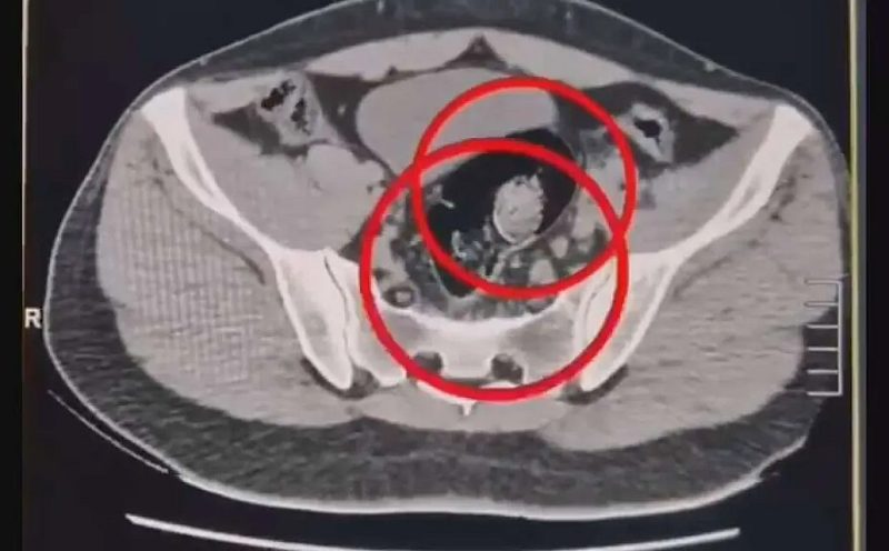 İran uyruklu 2 kuryenin makatından 307 gram uyuşturucu çıktı!