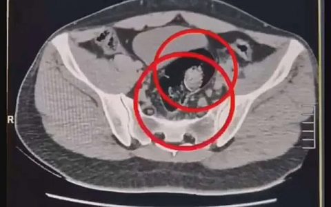 İran uyruklu 2 kuryenin makatından 307 gram uyuşturucu çıktı!