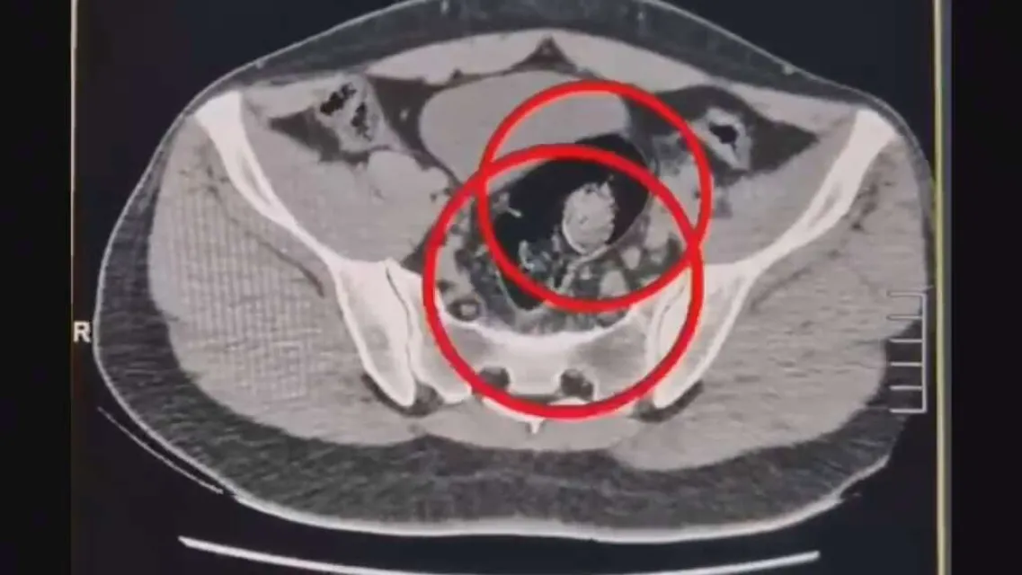 İran uyruklu 2 kuryenin makatından 307 gram uyuşturucu çıktı!
