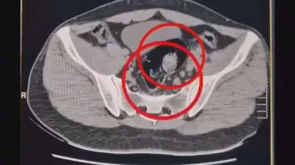 İran uyruklu 2 kuryenin makatından 307 gram uyuşturucu çıktı!